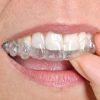 Understanding Invisalign Compliance and Why Wearing Time Directly Impacts Your Final Results
