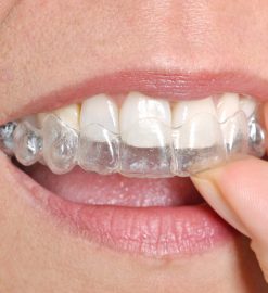 Understanding Invisalign Compliance and Why Wearing Time Directly Impacts Your Final Results