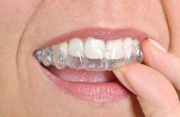 Understanding Invisalign Compliance and Why Wearing Time Directly Impacts Your Final Results