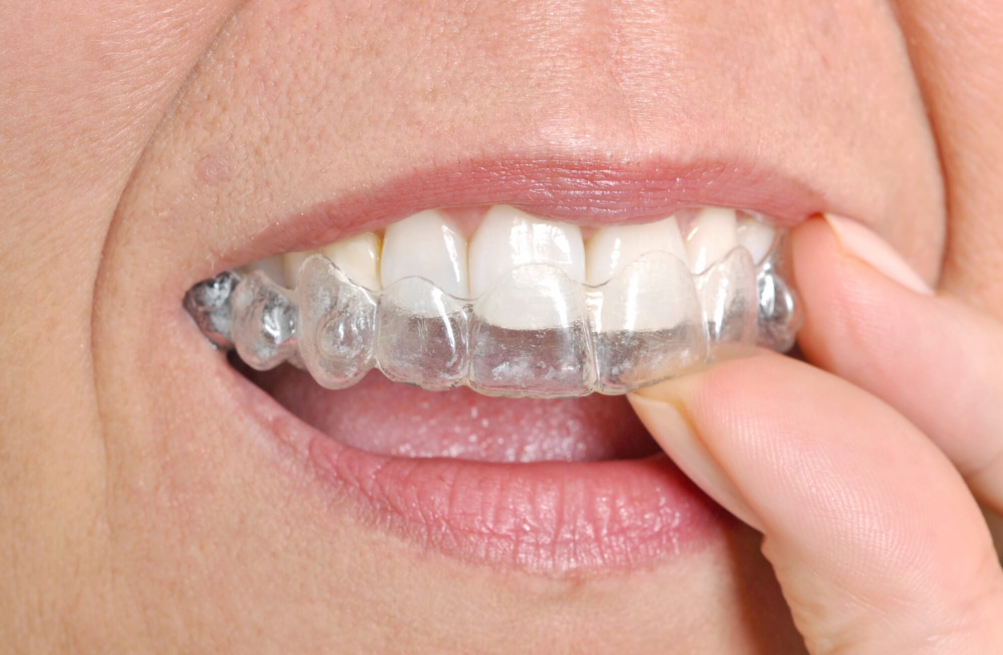 Understanding Invisalign Compliance and Why Wearing Time Directly Impacts Your Final Results